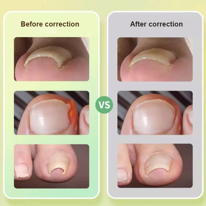 đŠ¶ TĂ„nagelkorrigeringsremsor â Omedelbar lindring och skonsam fixering